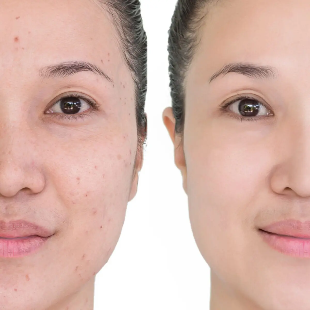 acne-1
