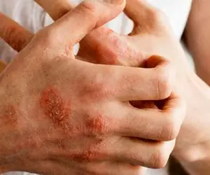 رفع خارش پوست بدون داروی شیمایی؛با این گیاهان خونگی از شرخارش خلاص شووو!