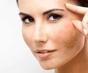 چطور لکه‌های پوستی‌رو از بین ببریم و از شرشون خلاص شویم؟