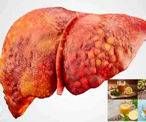 وایتکس کبد چرب کم هرینه و خونگی؛ پاکسازی کبد با این دمنوش های خونگی درمانگر