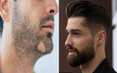 افزایش ریش مردان و از بین بردن طاسی اون؛ به ریش نیس به ریشه اس ولی برا گرو ریش میخوای