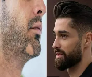 افزایش ریش مردان و از بین بردن طاسی اون؛ به ریش نیس به ریشه اس ولی برا گرو ریش میخوای