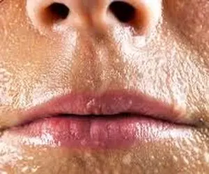 عرق سرد نشانه چیست و آیا باید از آن ترسید؟