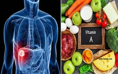 با این 6 مکمل و ویتامین کنترل کبد چرب تو مُشتت میاد؛ علائم گرید یک و روش بهبود بی قرص