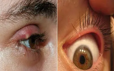 ترفند از بین بردن گل مژه در خانه و در عرض یک روز / بشمار سه خودتو خلاص کن