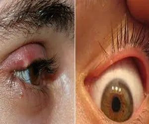 ترفند از بین بردن گل مژه در خانه و در عرض یک روز / بشمار سه خودتو خلاص کن