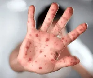 آیا آبله میمون به ایران می‌آید؟ پاسخ با مینو محرز