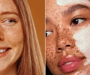 از بین بردن لک های قهوه ای صورت در خانه / ماهم پر از لکه ست ولی هنوزم خوشگله مثه تو