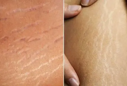 چطور بدون هزینه ترک‌ های پوستی را از بین ببریم؟ این راز را متخصصان زیبایی نمیگویند