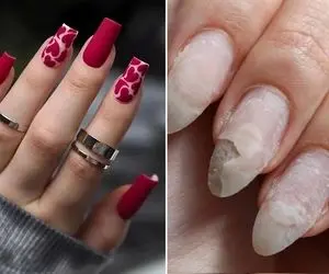 روش ضخیم کردن صدف ناخن و از بین بردن قارچ؛ تقویت موثر بعد از کاشت و ترمیم پشت هم