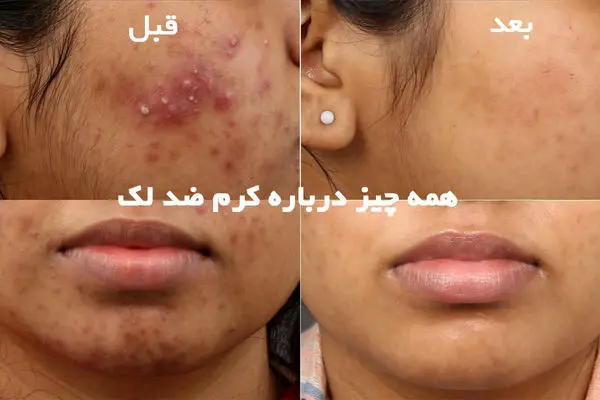 همه چیز درباره کرم ضد لک