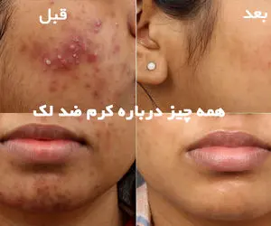 هر آنچه باید درباره کرم ضد لک بدانید