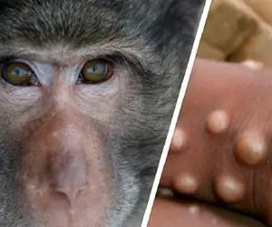 آبله میمون چیست و آیا این تاول های ترسناک که رسید بیخ گوش ایران مرگ و میر دارد؟