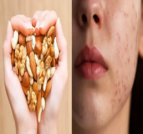 از بین بردن جوش های مجلسی تو عید / تو این ایام با پرخوری و خوردن آجیل جوش میزنی بیا