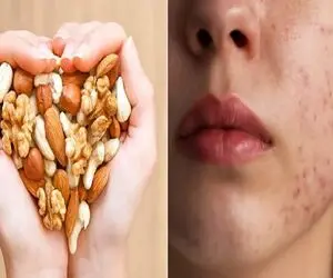 از بین بردن جوش های مجلسی تو عید / تو این ایام با پرخوری و خوردن آجیل جوش میزنی بیا
