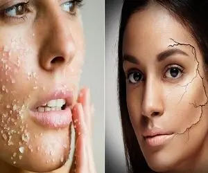 از بین بردن خشکی پوست تو خونه / با سرد شدن هوا بدترم میشه و پوسته میده؟ دست بجنبون