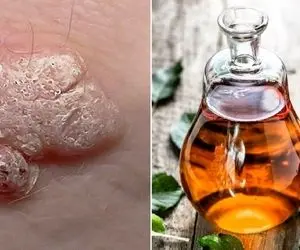 درمان کوتاه مدت زگیل هولناک تناسلی در خانه/ سلامتیت رو از دل طبیعت به دست بیار