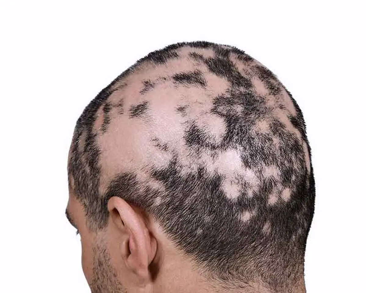 alopecia-areata