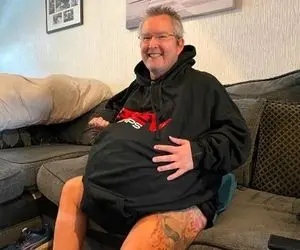 (عکس) مردی با کلیه‌های ۳۰کیلویی رکورددار جهان شد