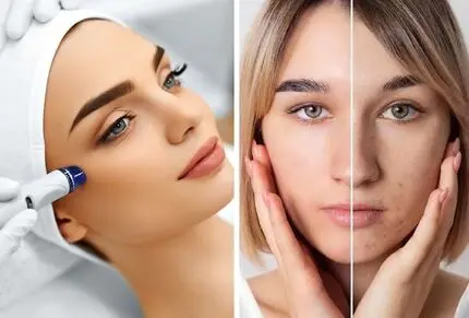 میکرودرم واقعا صورت رو جوان میکنه یا نه؟ عوارض، مراقبت ها و پوست هایی که لازمشونه