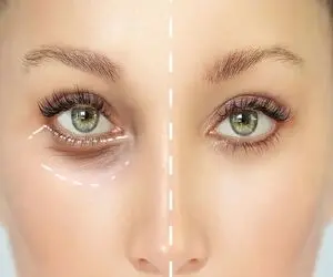 خداحافظی با تیرگی و گودی زیر چشم؛ این دمنوش ها و گیاهان روغنی حلقه های سفید دور چشم ایجاد میکنند!