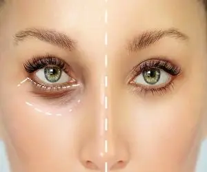 خداحافظی با تیرگی و گودی زیر چشم؛ این دمنوش ها و گیاهان روغنی حلقه های سفید دور چشم ایجاد میکنند!