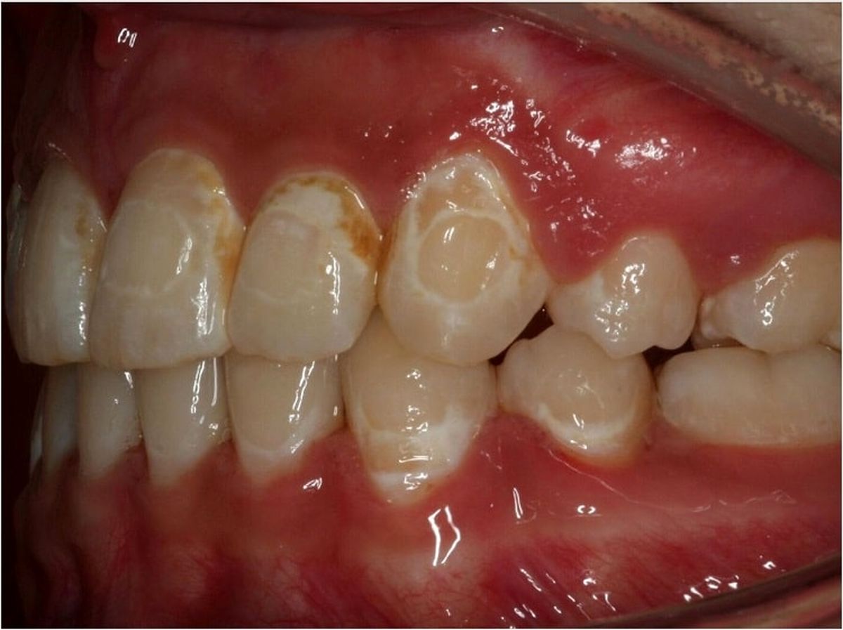 علائم-پوسیدگی-دندان-طی-درمان-ارتودنسی-min