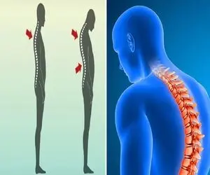 متخصص ترین پزشک ها برای درمان قوز کمر در کرج / درمانی در سطح بین المللی