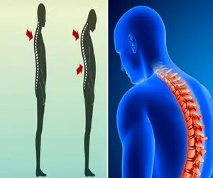 متخصص ترین پزشک ها برای درمان قوز کمر در کرج / درمانی در سطح بین المللی