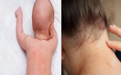 ترفند جلوگیری از عرق سوز در گرمای تابستون / این ماده آب رو آتیشه برا سوزش پوستت