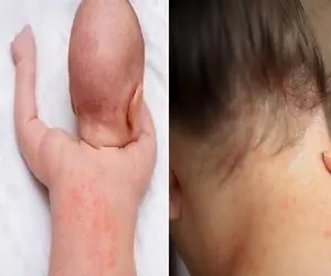 ترفند جلوگیری از عرق سوز در گرمای تابستون / این ماده آب رو آتیشه برا سوزش پوستت