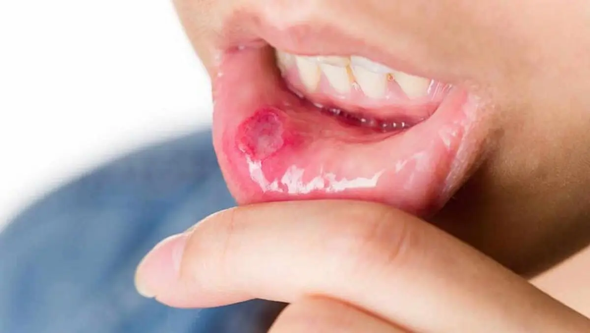 ulcer