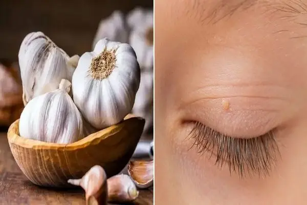 از بین بردن منگوله های پوستی با روش خونگی / لیزر نکن با این ماده دو روزه نابود میشن 