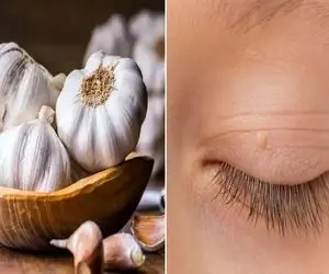 از بین بردن منگوله های پوستی با روش خونگی / لیزر نکن با این ماده دو روزه نابود میشن 