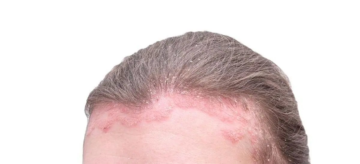 Scalp_mushroom