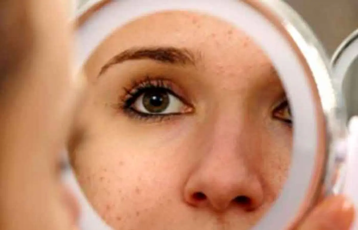 جلوگیری-از-جوش-زدن-در-تابستان-1024x658