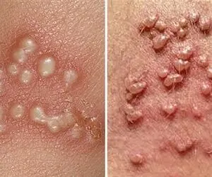 بهترین پزشکهای تهران برای درمان زگیل تناسلی؛ تفاوت و تشخیص جوش، تبخال و HPV