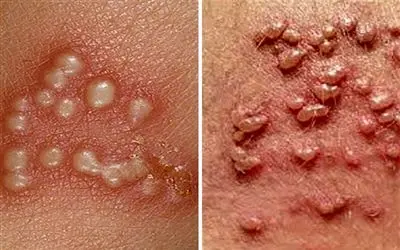 بهترین پزشکهای تهران برای درمان زگیل تناسلی؛ تفاوت و تشخیص جوش، تبخال و HPV