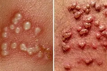 بهترین پزشکهای تهران برای درمان زگیل تناسلی؛ تفاوت و تشخیص جوش، تبخال و HPV
