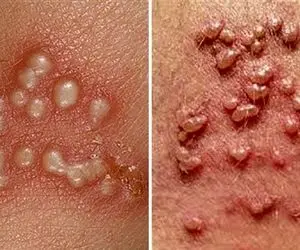 بهترین پزشکهای تهران برای درمان زگیل تناسلی؛ تفاوت و تشخیص جوش، تبخال و HPV