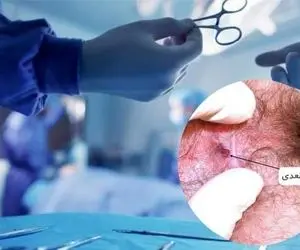 آشنایی با علائم شقاق یا زخم مقعدی و بهترین روش های جراحی