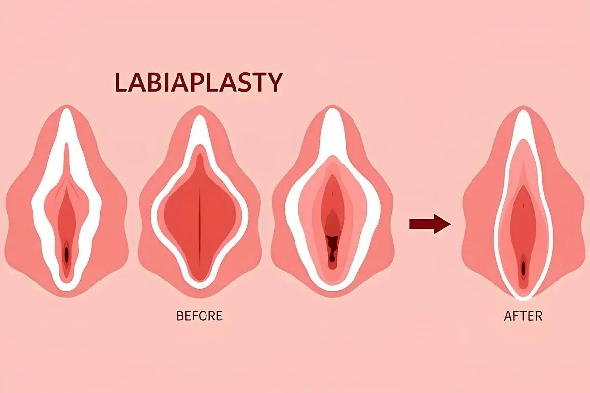 لابیاپلاستی با بیمه