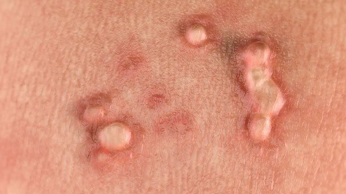 hpv-warts-722x406