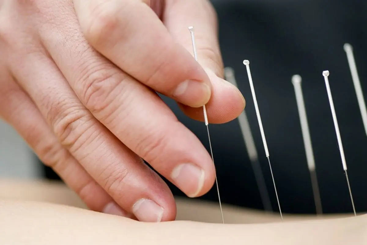 acupuncture-fertility-male