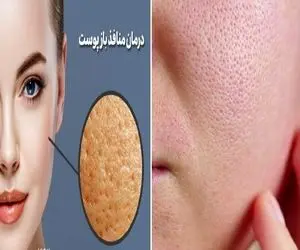 چطور منافذ باز پوست رو ببندیم؟ / یادت باشه پوست سالم نباید مثل توت فرنگی دون دون باشه