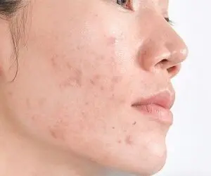 چگونه از شر لکه های سیاه روی پوست خلاص شویم