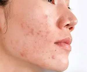 چگونه از شر لکه های سیاه روی پوست خلاص شویم