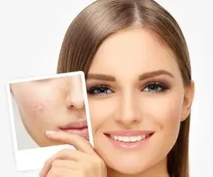 هفت روش طبیعیِ از بین بردنِ جای جوش؛ برای شمایی که پوستی صاف می خواهید