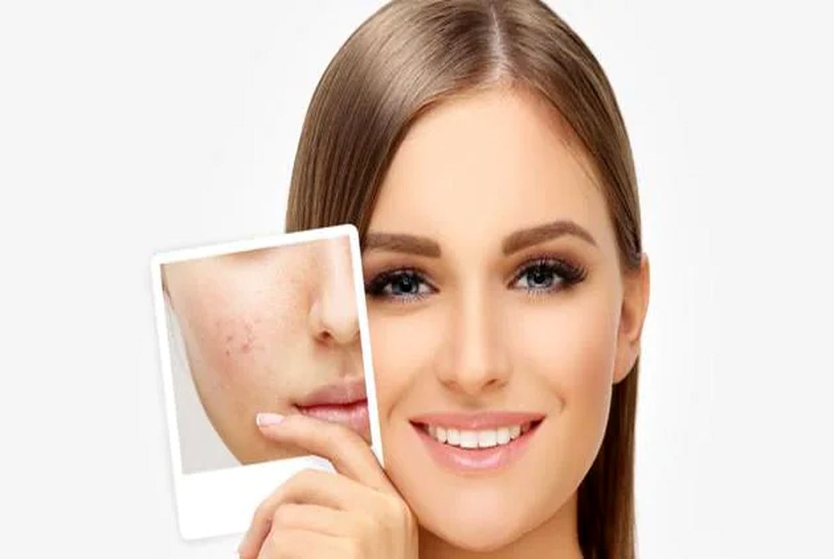 Natural Products to Get Rid of Acne Scars