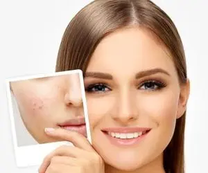 هفت روش طبیعیِ از بین بردنِ جای جوش؛ برای شمایی که پوستی صاف می خواهید